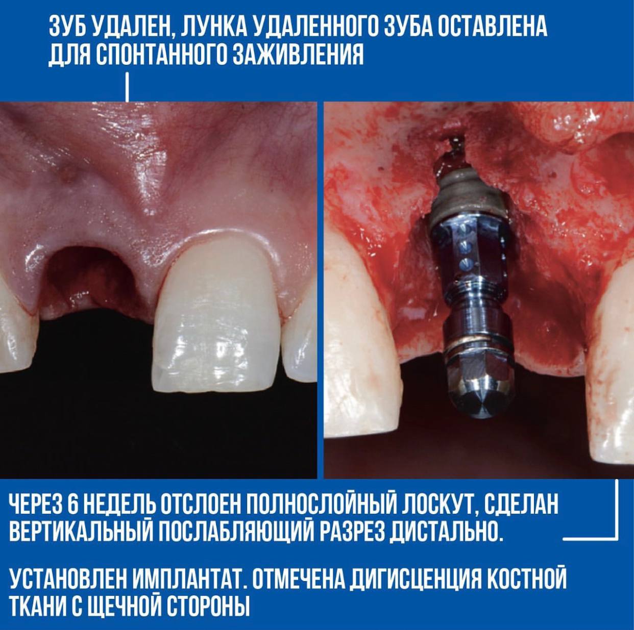 Техника L-shape. Клинический случай Рональда Юнга